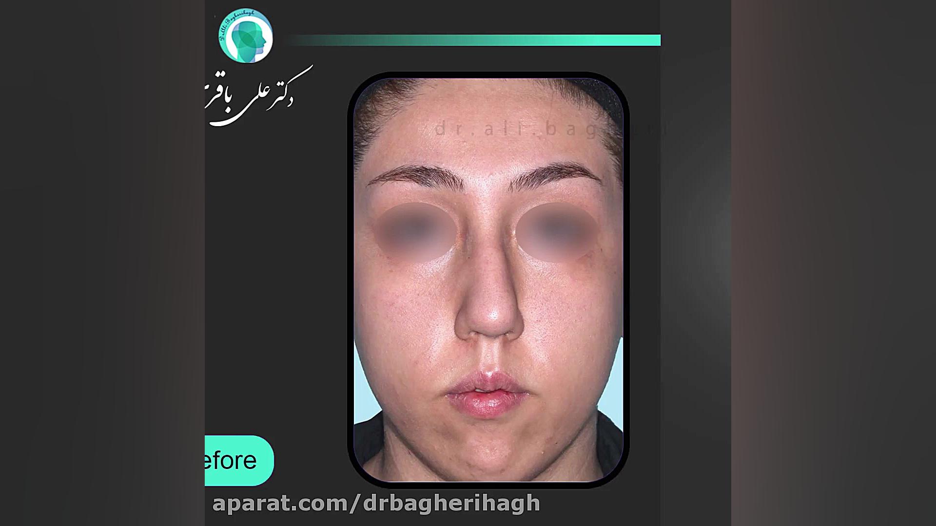 قبل و بعد از جراحی زیبایی بینی | جراح بینی دکتر علی باقری حق