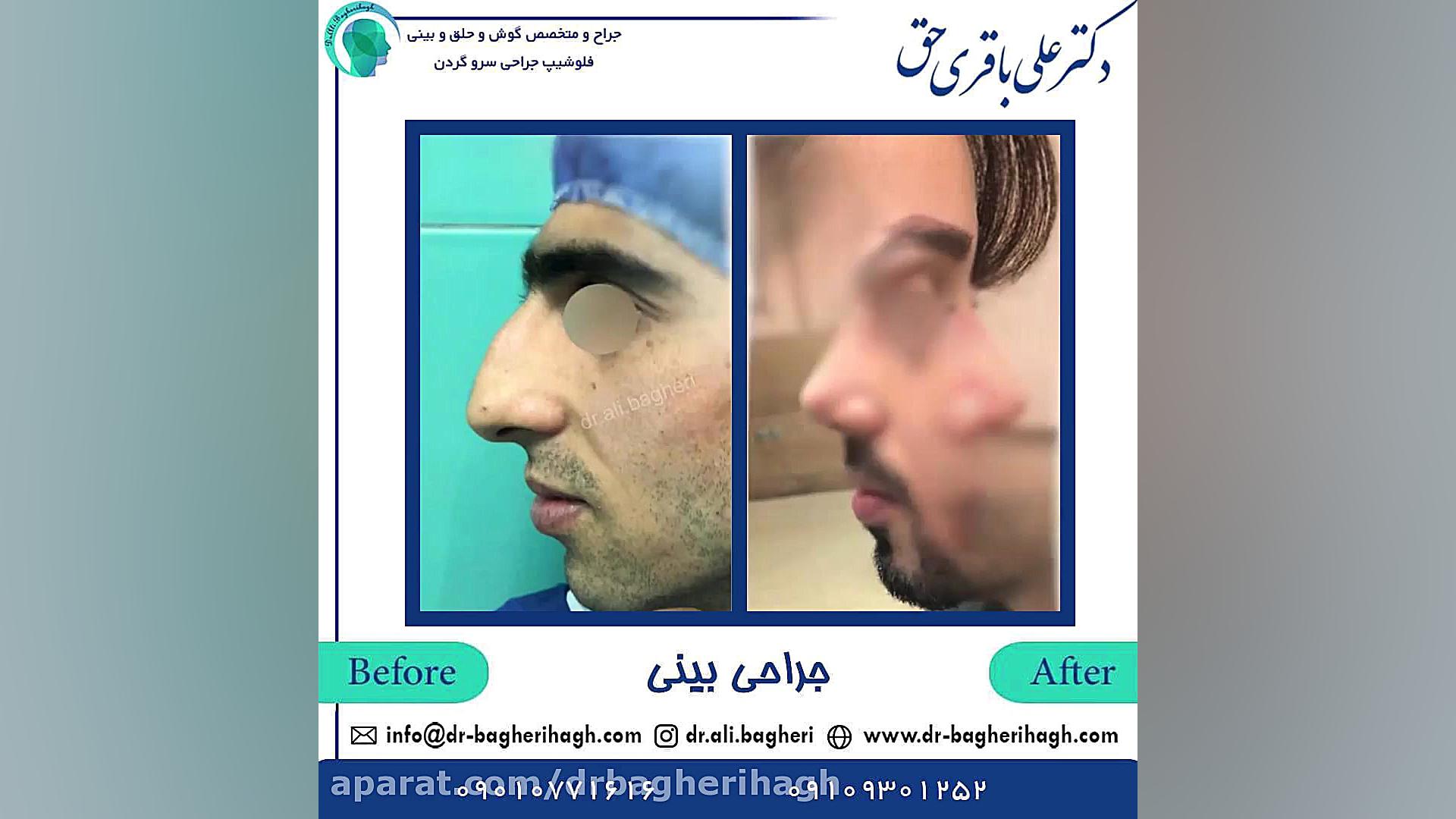 نمونه کارهای جراحی بینی | جراح بینی تهران دکتر علی باقری حق