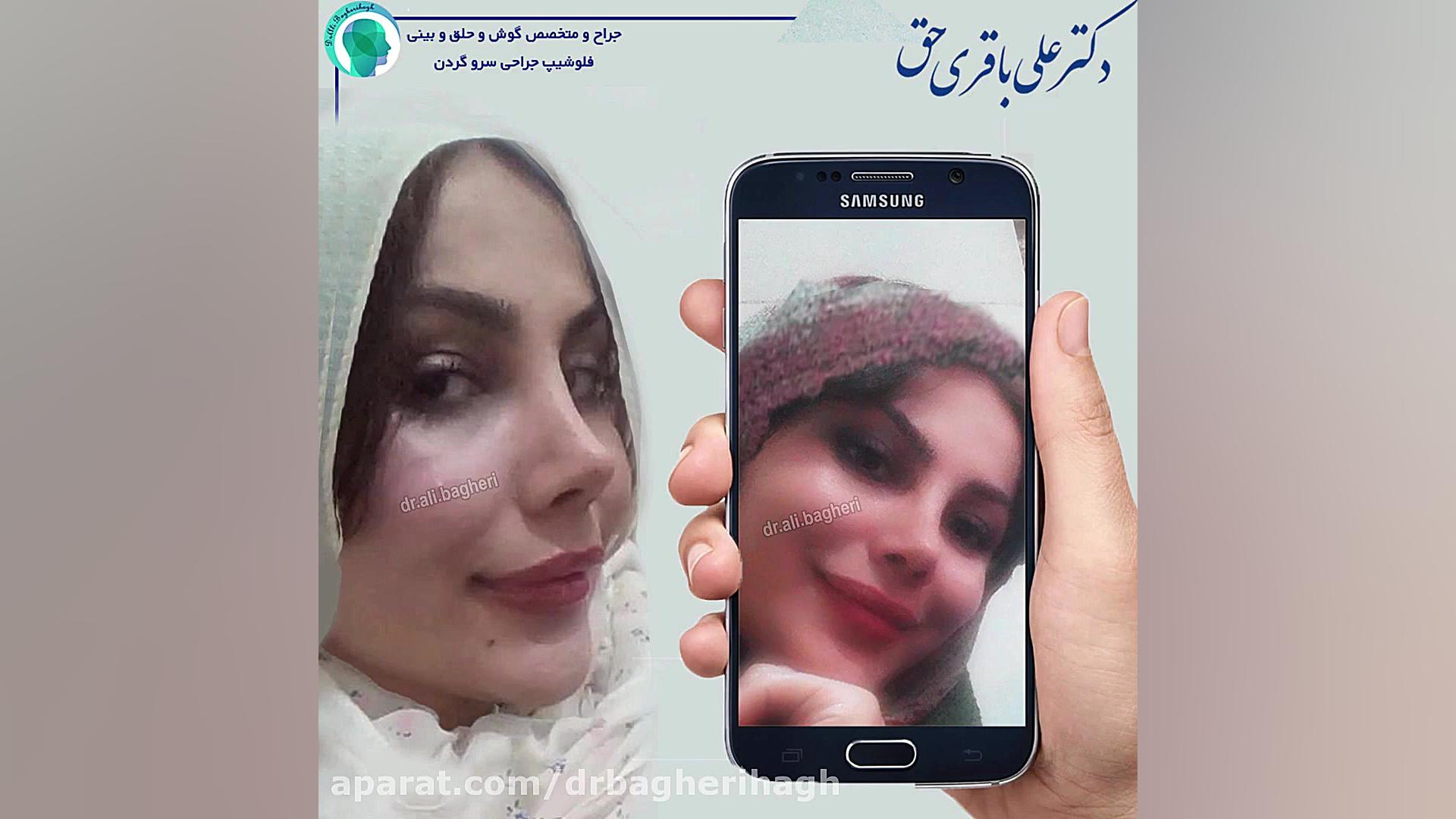 نمونه کار جراحی زیبایی بینی | جراحی بینی تهران دکتر علی باقری حق