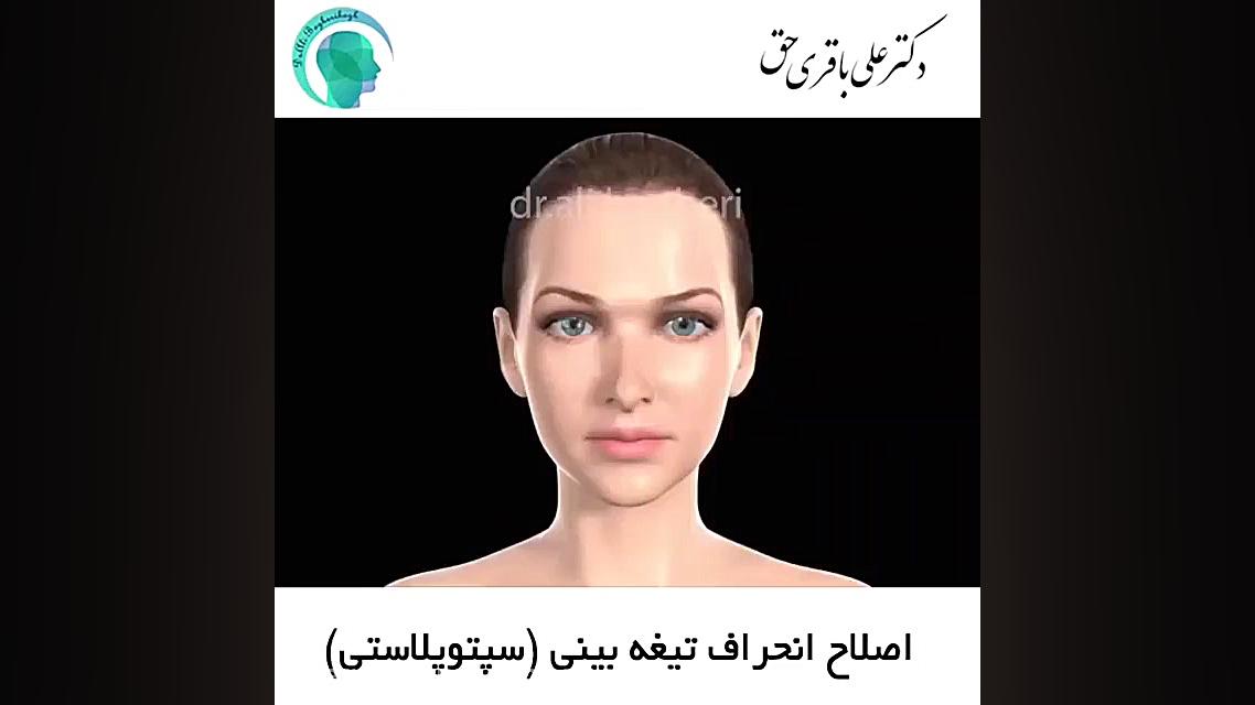 اصلاح انحراف تیغه بینی دکتر علی باقری حق