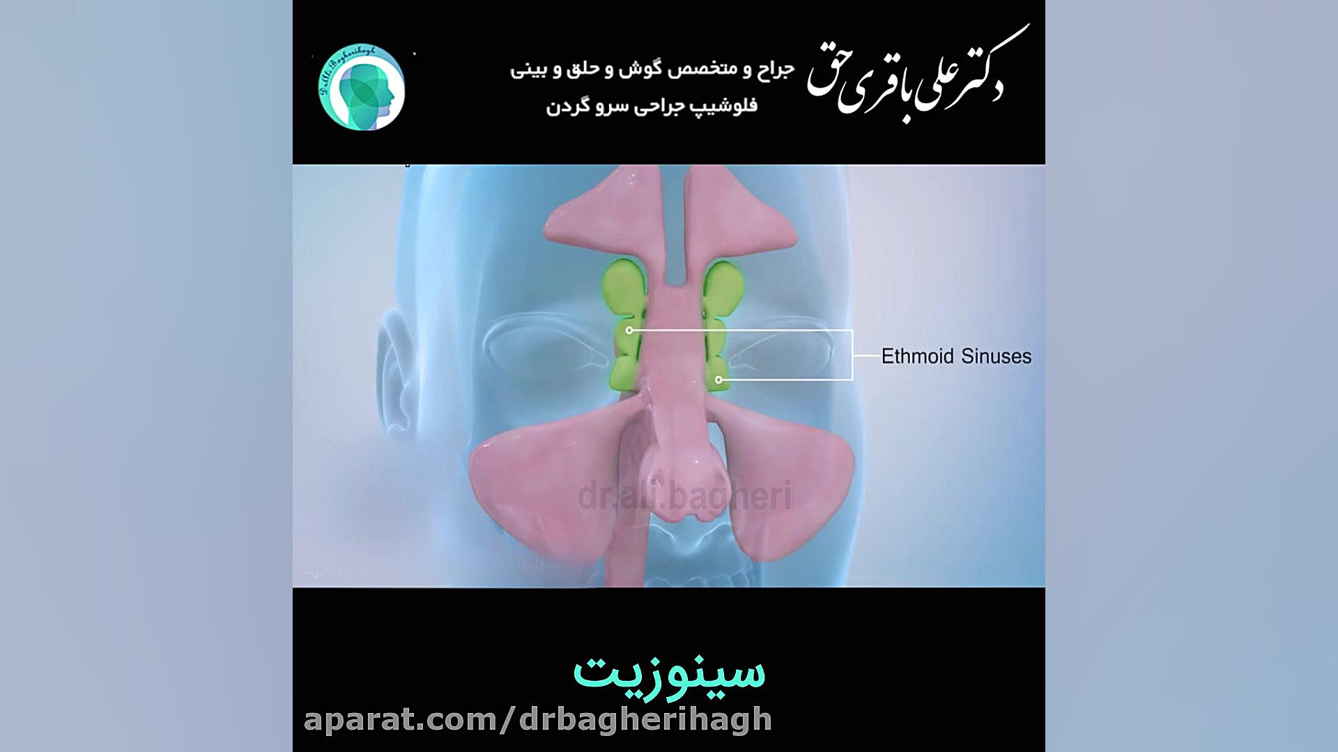 سینوزیت دکتر علی باقری حق