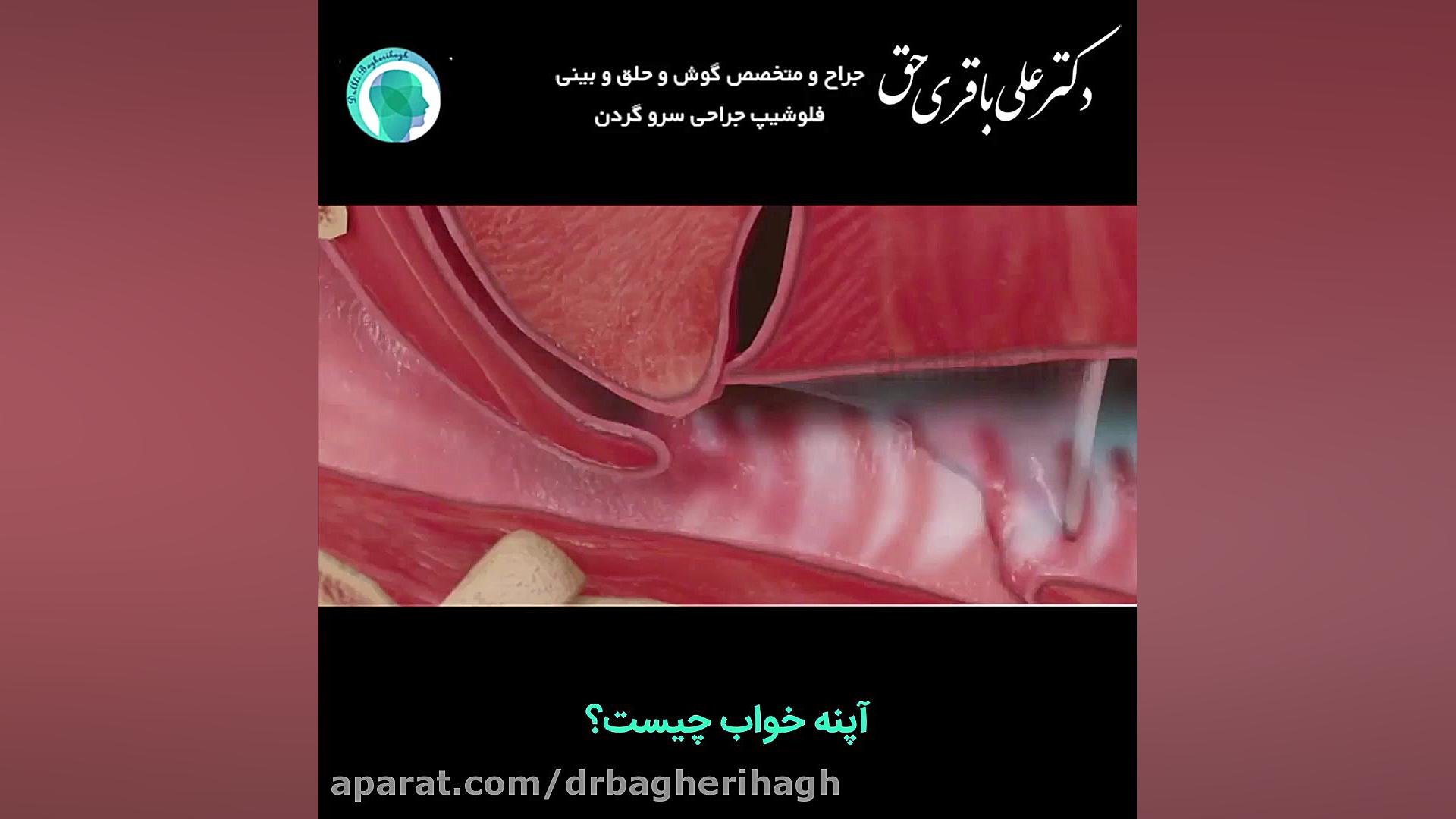 آپنه خواب چیست ؟ دکتر علی باقری حق