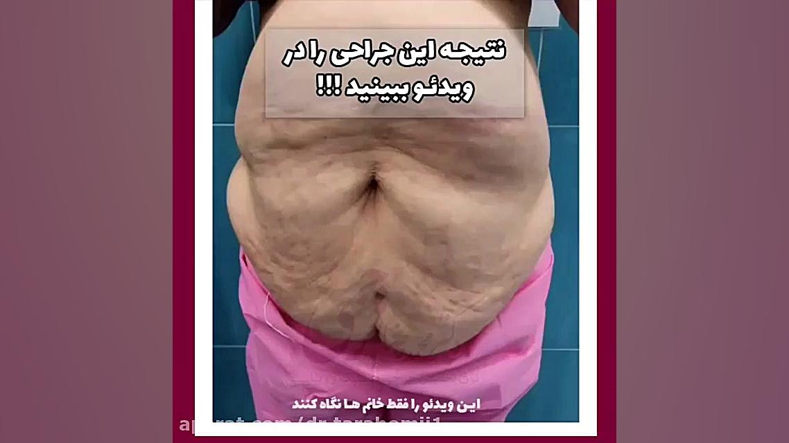 فیلم بدون سانسور لیپوماتیک شکم دستگاه بیوسنسور عرق