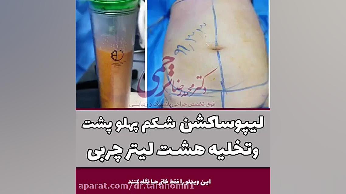 لیپوساکشن شکم و پهلو و تخلیه 8 لیتر چربی کلینیک مو
