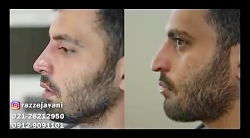 اصلاح قوس بینی و نوک بینی در ۲...