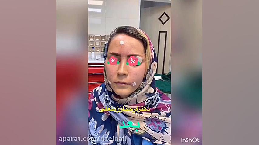 تزریق چربی به صورت دکتر فرحناز زینعلی - متخصص پوست، مو، زیبایی زنجان