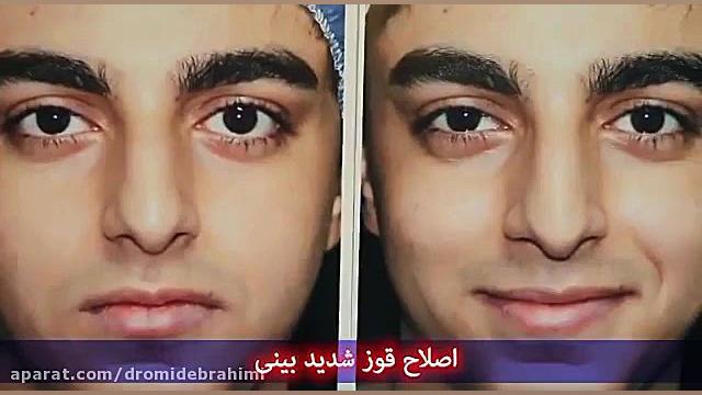 برطرف کردن قور شدید بینی توسط دکتر امید ابراهیمی بهترین جراح بینی در تهران دکتر امید ابراهیمی