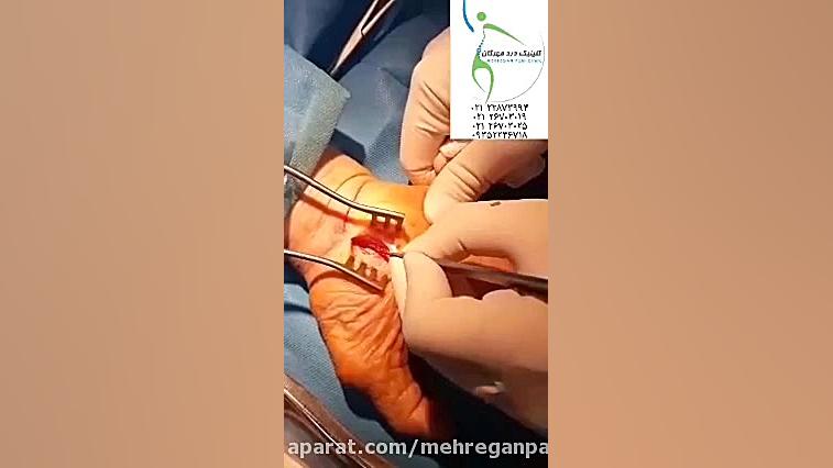 آزاد کردن عصب دست در بیماری سندروم تونل کارپ . کلینیک درد مهرگان کاشت مو