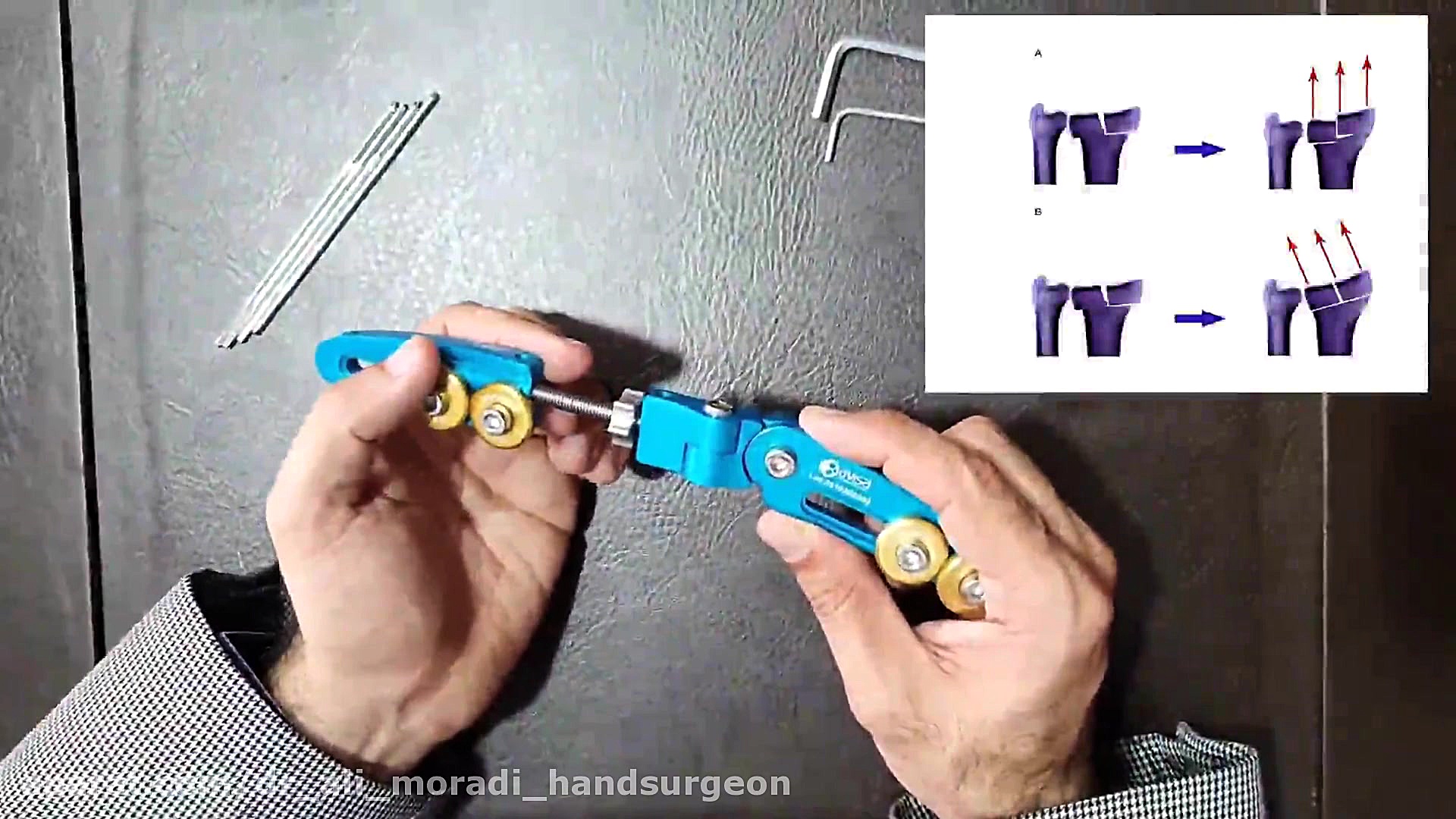 اکسترنال فیکساتور دیستال رادیوس Dynamic Distal Radius External Fixator دکتر علی مرادی جراح دست