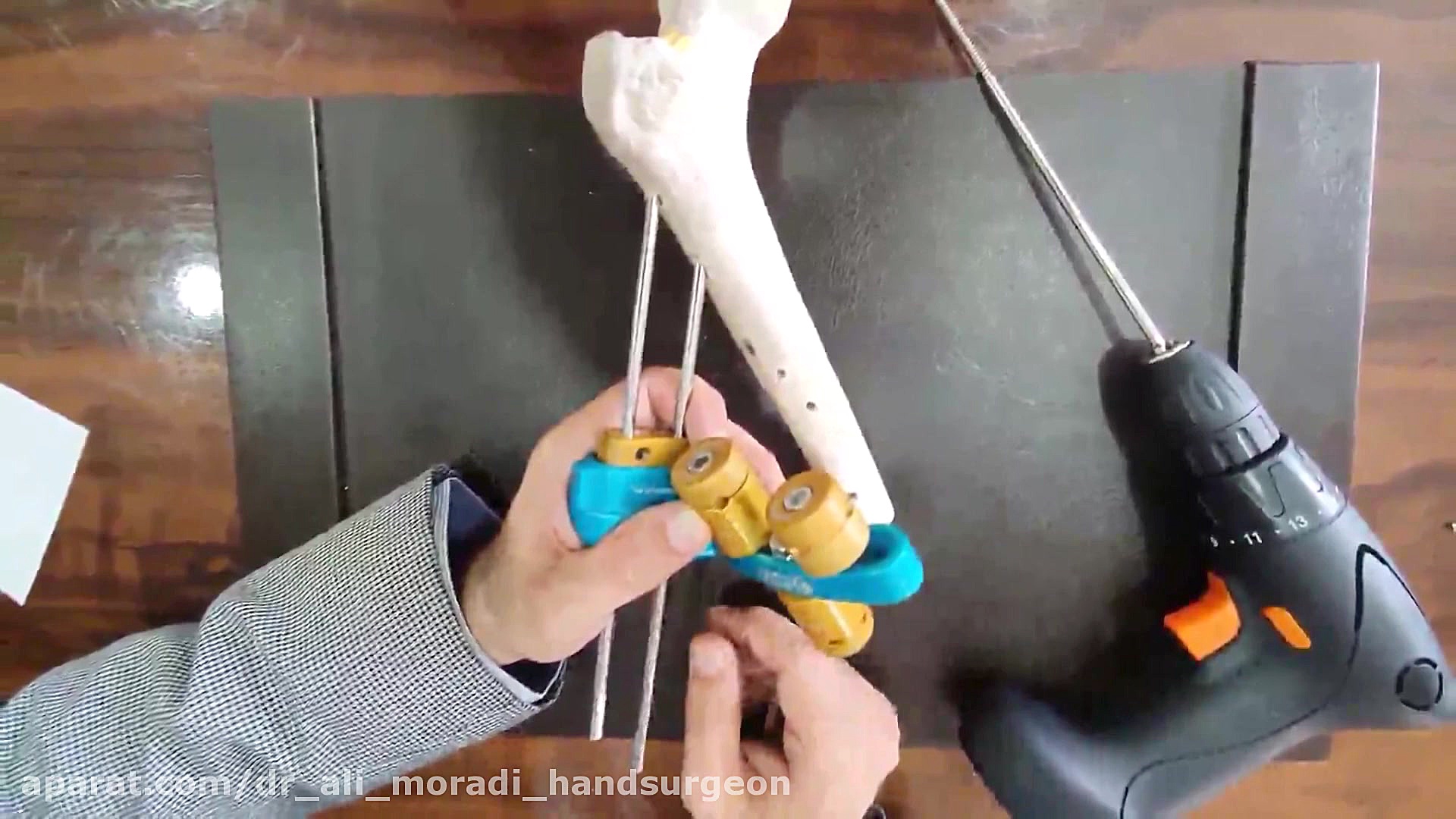 اکسترنال فیکساتور دینامیک هیپ Dynamic Hip External Fixator دکتر علی مرادی جراح دست