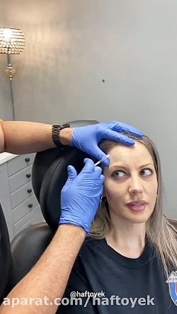 استفاده از بوتاکس برای لیفت اب...