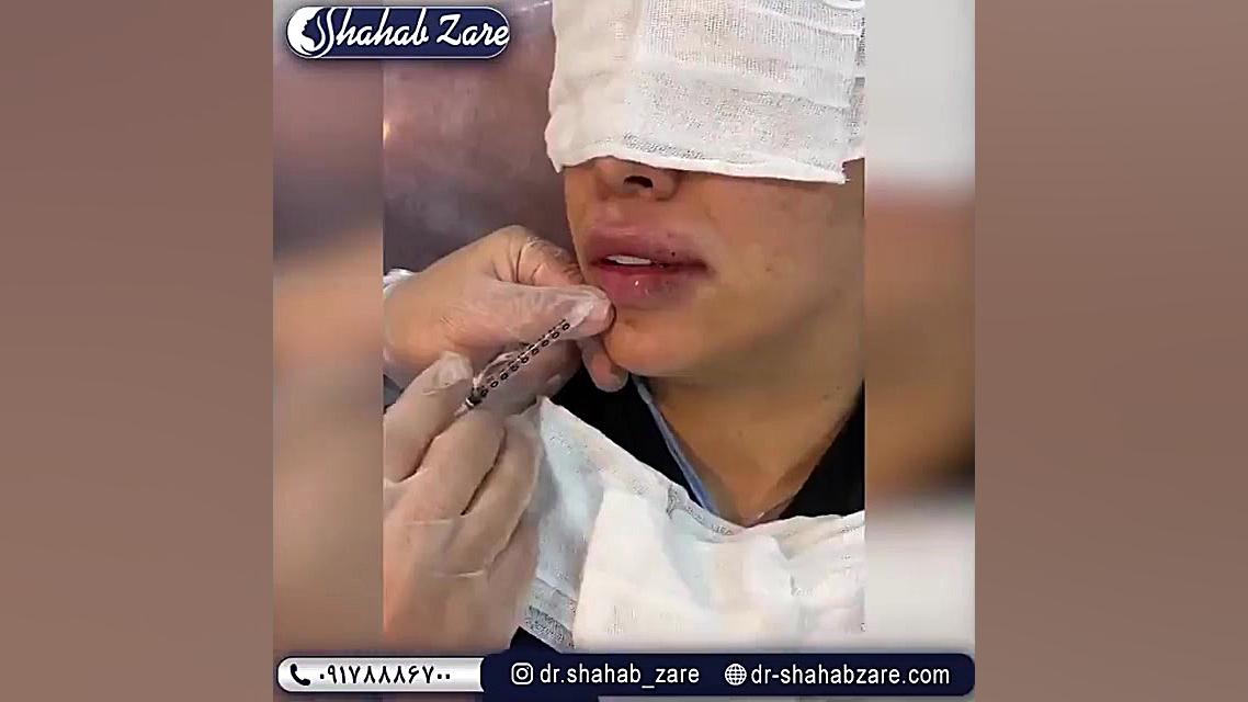 فیلم تزریق آنزیم برای از بین بردن ژل میوکلونوس