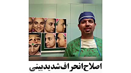 اصلاح انحراف شدید بینی توسط دکتر امید ابراهیمی بهترین جراح بینی در تهران دکتر امید ابراهیمی
