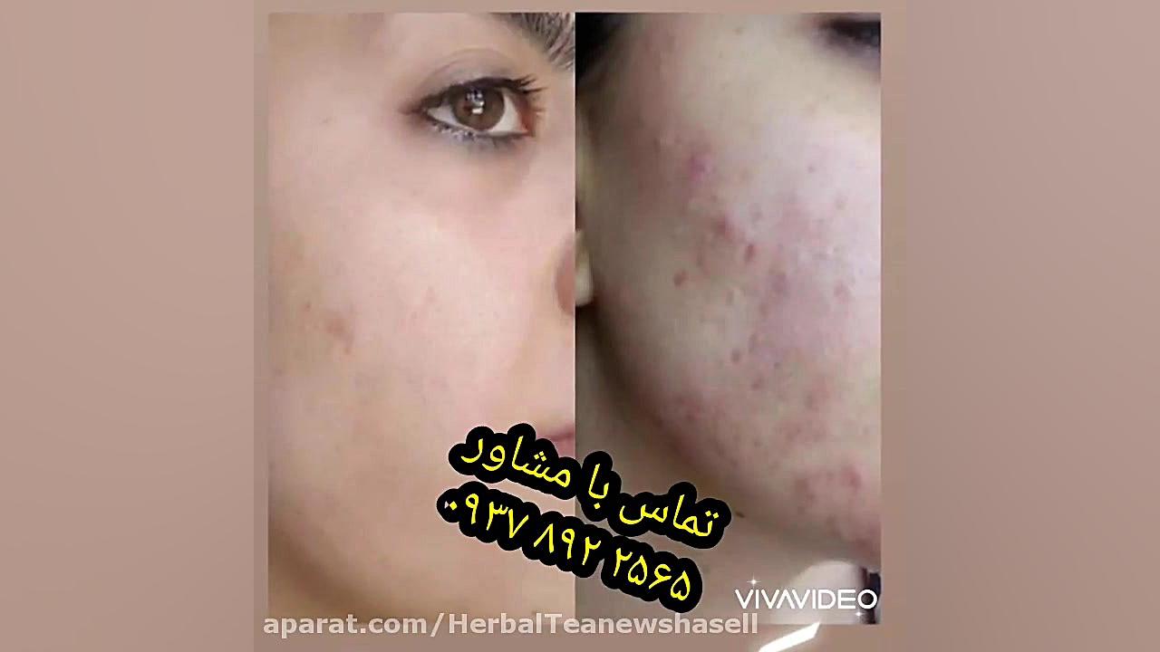 دمنوش نیوشا|مشاور نیوشا|دمنوش پاکسازی پوست نیوشا|برطرف کردن جوش|ترمیم پوست رفع چین و چروک