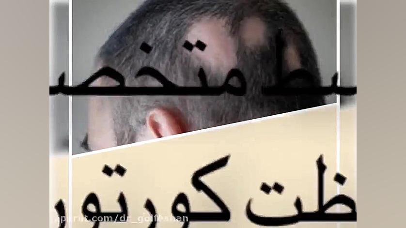 ریزش موی سکه ای و درمان آن دکتر عاطفه گلفشان، متخصص پوست مو و لیزر درمانی