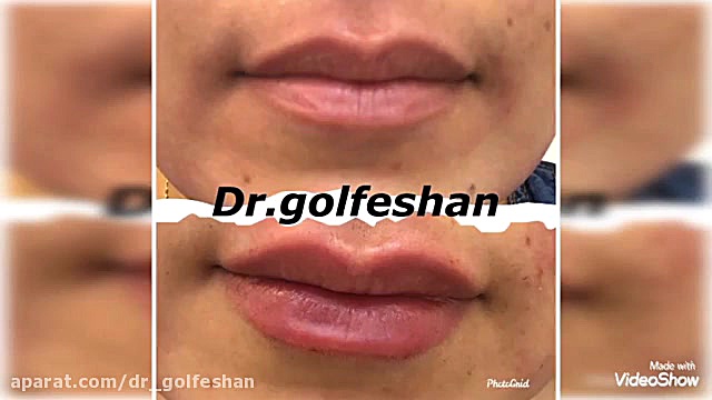 ژل لب طبیعی دکتر عاطفه گلفشان، متخصص پوست مو و لیزر درمانی