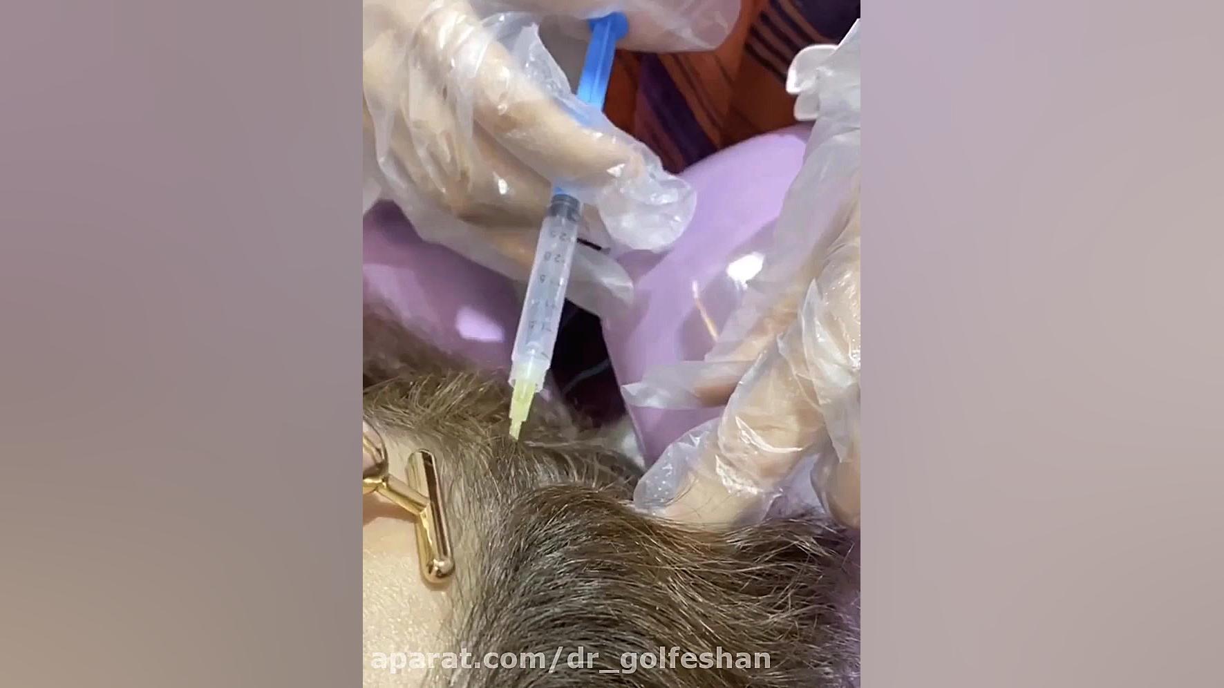 مزوتراپی مو برای کنترل ریزش و افزایش ضخامت مو دکتر عاطفه گلفشان، متخصص پوست مو و لیزر درمانی