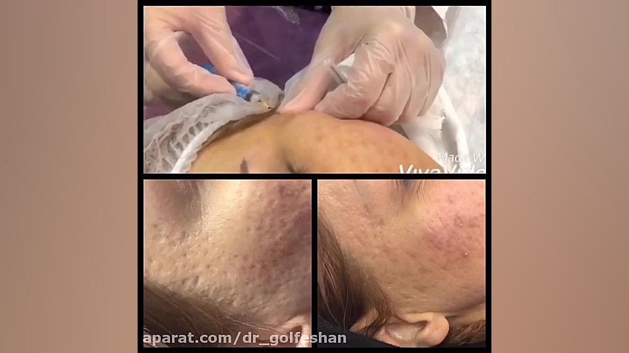درمان جای جوش دکتر عاطفه گلفشان، متخصص پوست مو و لیزر درمانی
