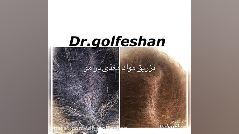 درمان ریزش مو با مزوتراپی دکتر عاطفه گلفشان، متخصص پوست مو و لیزر درمانی