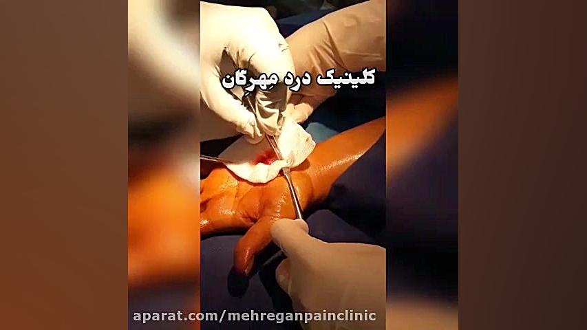 درمان تنگی کانال مچ دست . کلینیک درد مهرگان جراحی پف زیر چشم