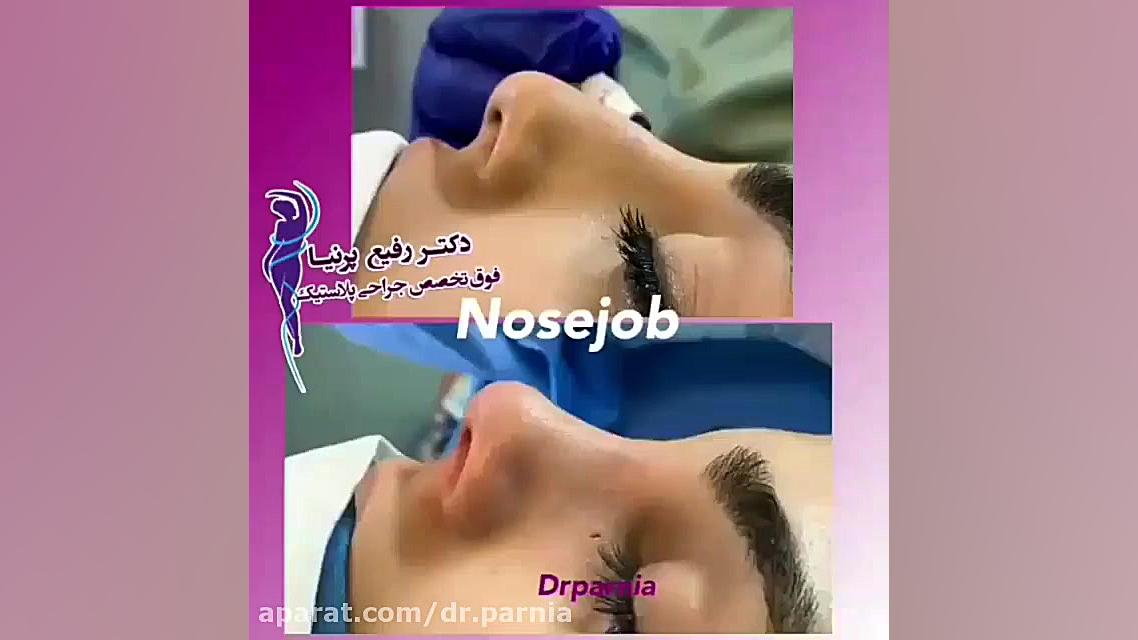 جراحی زیبایی بینی دکتر رفیع پرنیا فوق تخصص پلاستیک