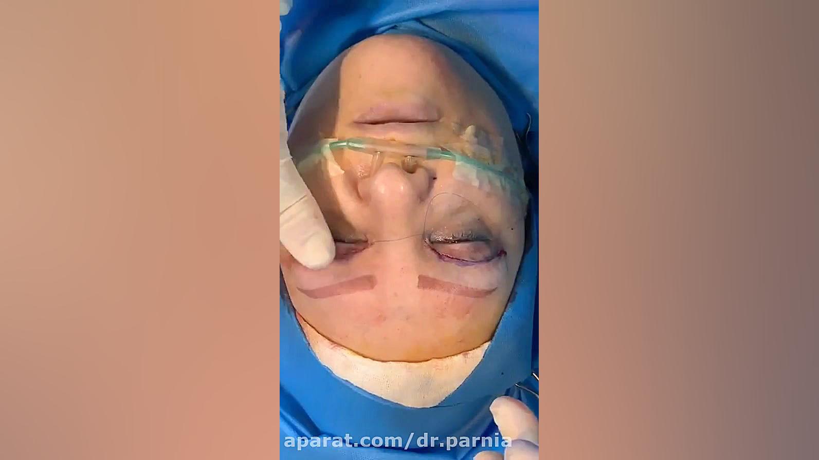 فیلم بلفاروپلاستی در حین عمل دکتر رفیع پرنیا فوق تخصص پلاستیک