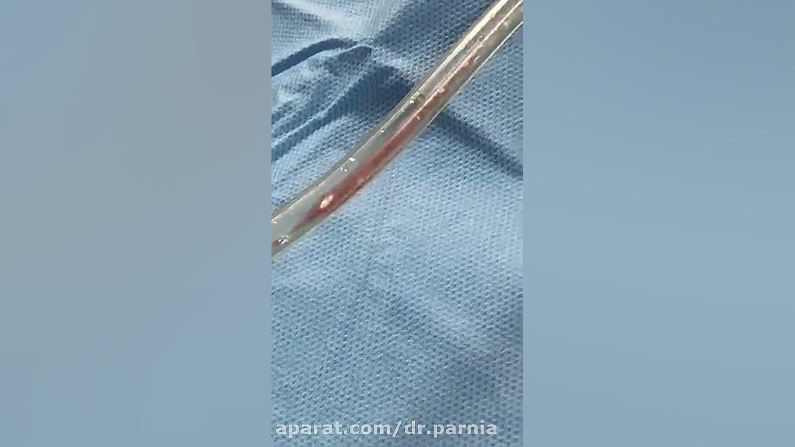 فیلم پیکرتراشی با سیستم پال در حین عمل دکتر رفیع پرنیا فوق تخصص پلاستیک