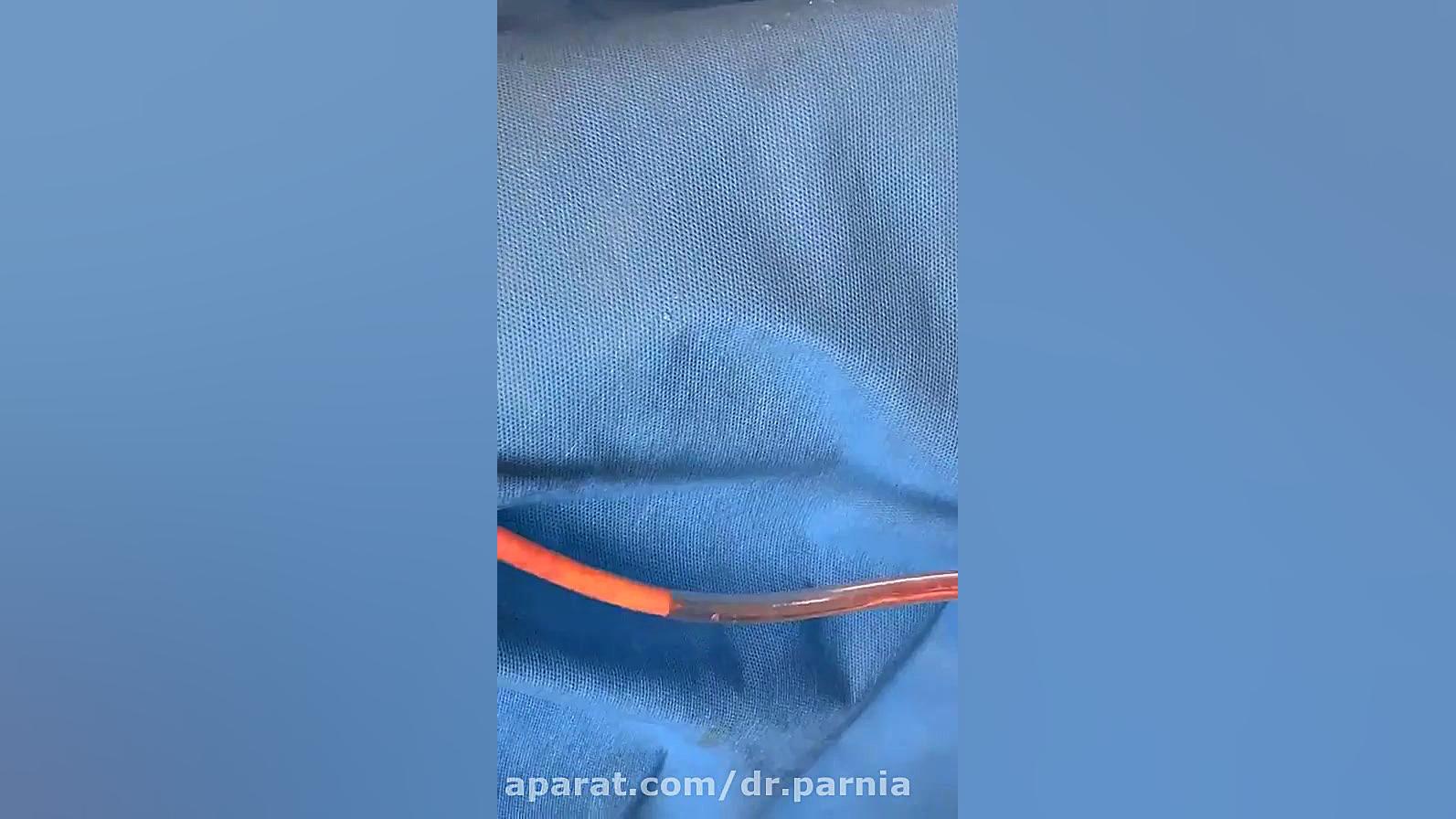 فیلم لحظه لیپوماتیک شکم و پهلو به همراه ابدومینوپلاستی دکتر رفیع پرنیا فوق تخصص پلاستیک