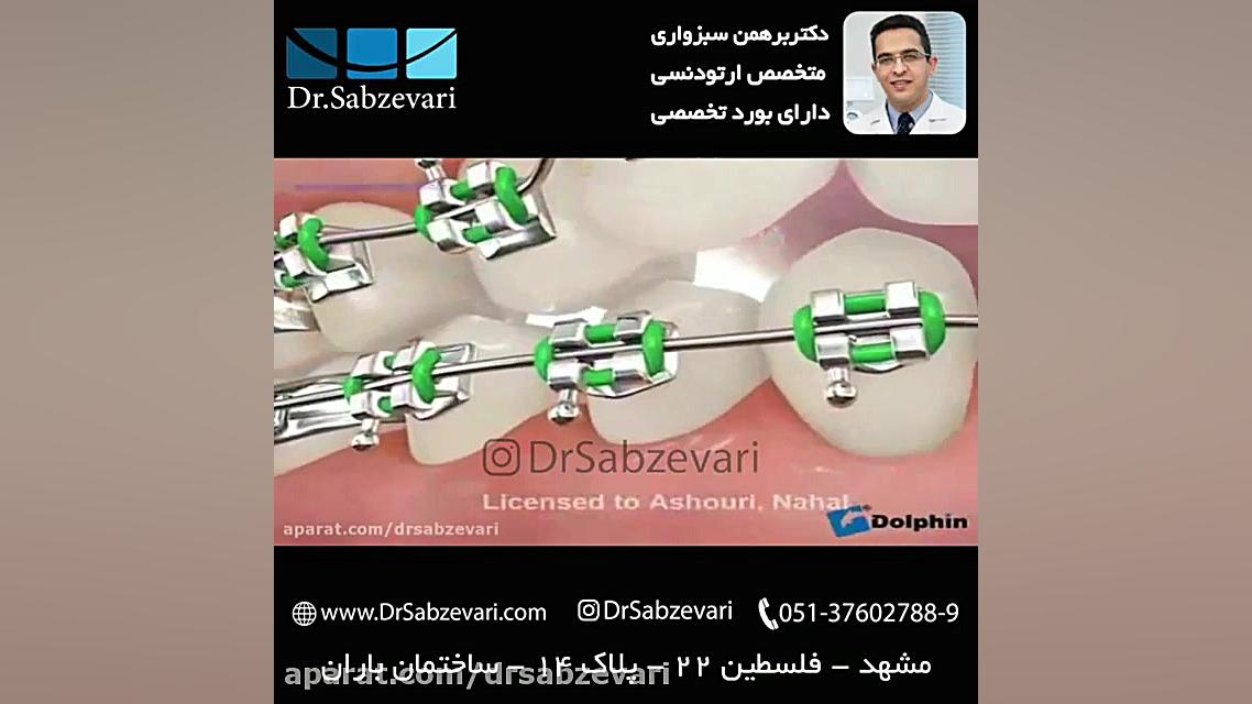 عوارض شکسته شدن براکت (نگین) در ارتودنسی ثابت دکتر برهمن سبزواری - متخصص ارتودنسی - مشهد