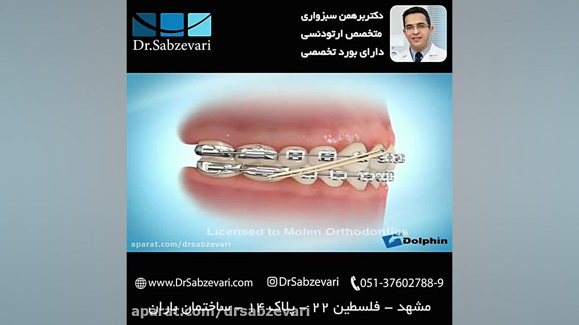 کش (الاستیک) بین فکی در ارتودنسی ثابت- 2 دکتر برهمن سبزواری - متخصص ارتودنسی - مشهد