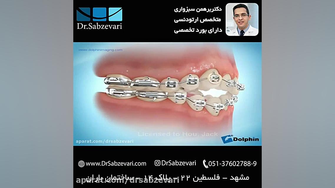 کش (الاستیک) بین فکی در ارتودنسی ثابت-3 دکتر برهمن سبزواری - متخصص ارتودنسی - مشهد