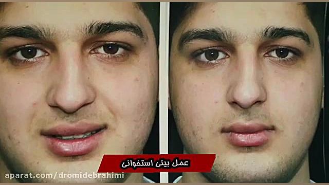 جراحی بینی استخوانی و برطرف کردن قوز بینی توسط دکتر امید ابراهیمی دکتر امید ابراهیمی