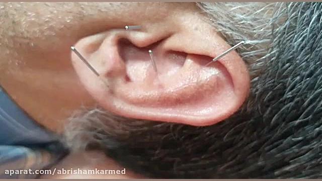 درمان ریزش مو با استفاده از طب سوزنی Organoid Viability Test