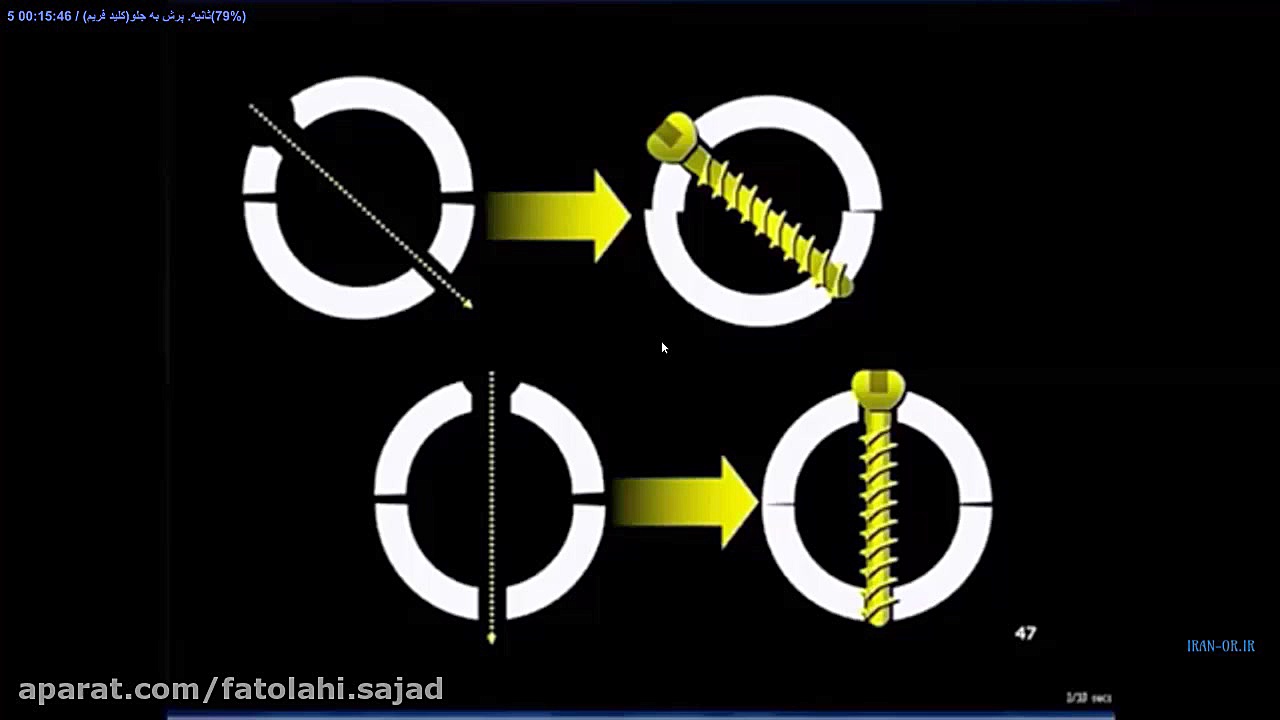 آموزش انواع پیچ های ارتوپدی و مکانیسم عمل آنها با دوبله فارسی رفع غبغب