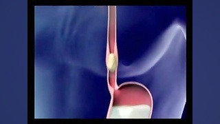 دستگاه گوارش برداشتن خال گوشتی