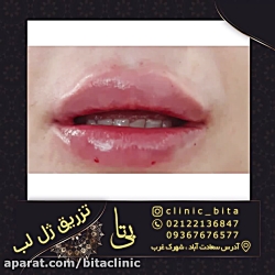 تزریق ژل لب در کلینیک بی تا