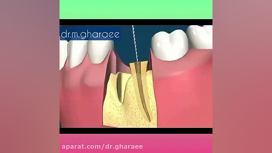انیمیشین مراحل درمانی کانال ریشه دکتر مریم قرایی