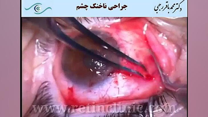 جراحی ناخنک چشم دکتر محمد باقر رجبی -فوق تخصص شبکیه و لیزر
