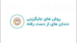 روش های جایگزینی دندان های از دست رفته ایمونوانژیوگرافی