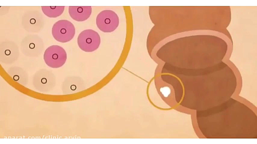 آشنایی با سرطان روده و راه‌های پیشگیری و درمان آن . دندانپزشکی کودکان