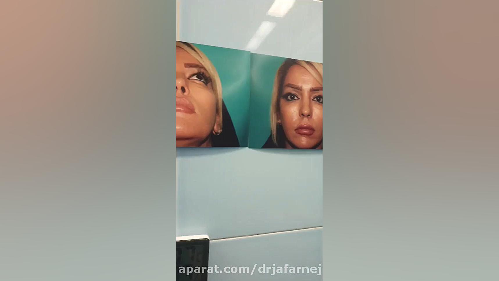 جراحی بینی حین عمل دکتر بابک جعفرنژاد
