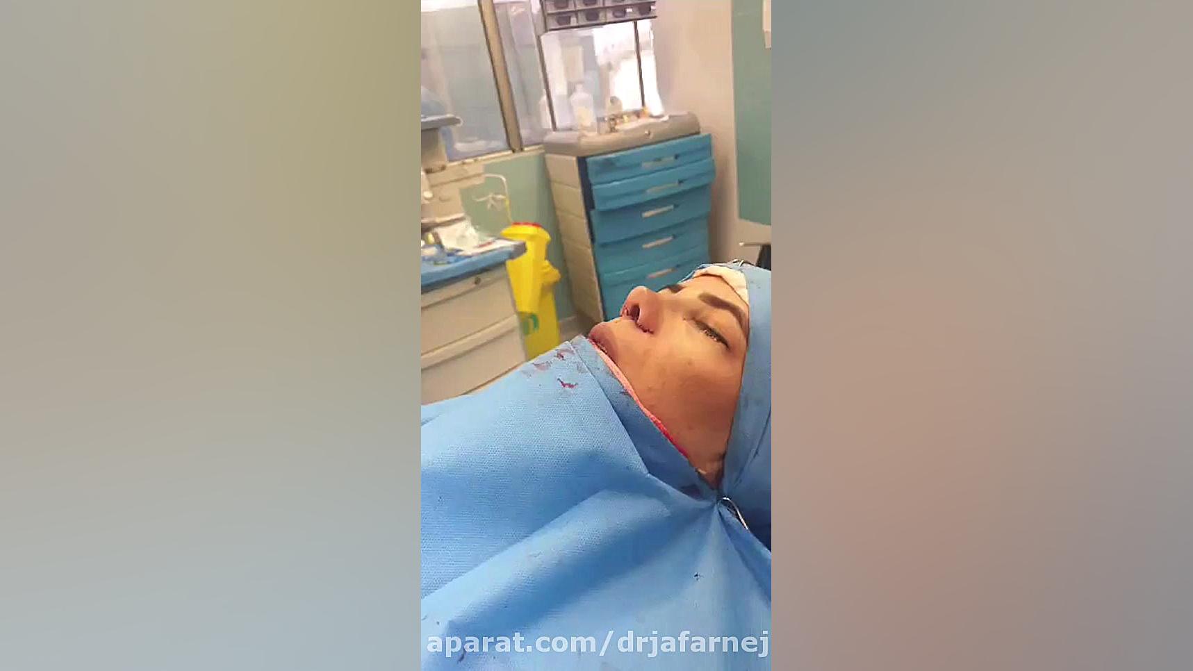 فیلم بدون سانسور جراحی بینی حین عمل دکتر بابک جعفرنژاد