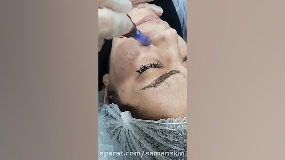 مرو میکروبیولوژی بابت رفع ضایعات پوستی صورت و روشن شدن و خوانساری پوست صورت سر به هوا