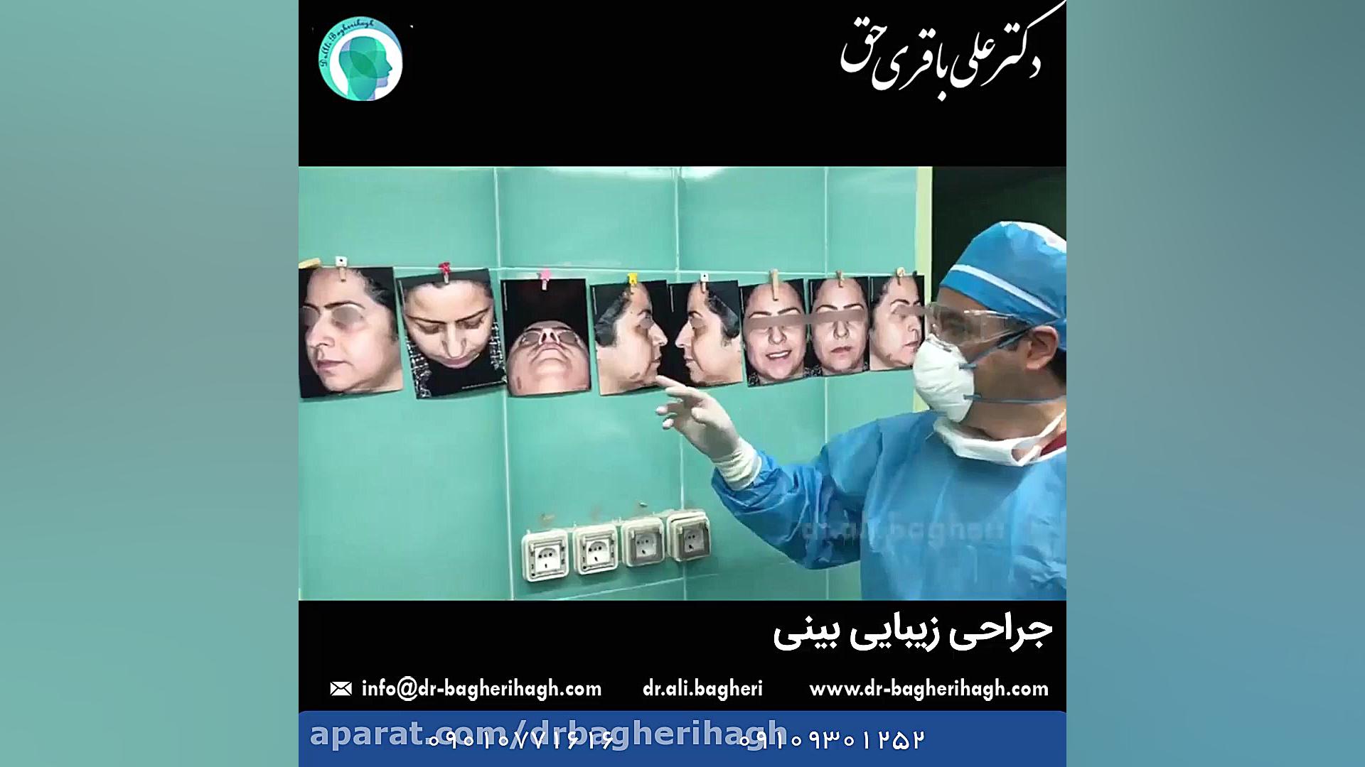 نمونه جراحی زیبایی بینی دکتر علی باقری حق