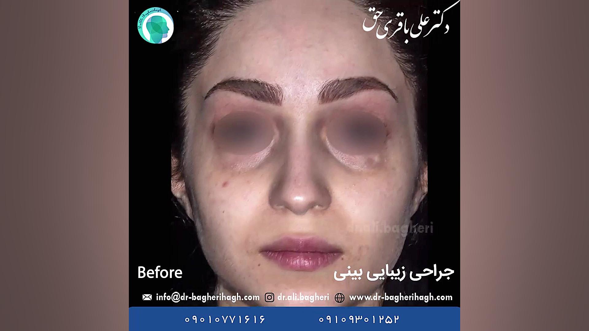 نمونه جراحی زیبایی بینی نیمه فانتزی دکتر علی باقری حق