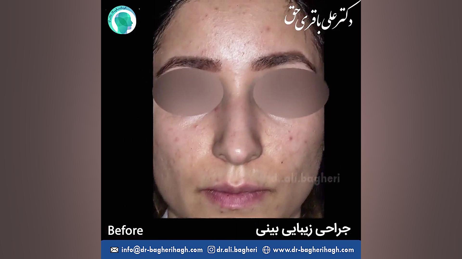 نمونه کار جراحی زیبایی بینی | دکتر باقری حق دکتر علی باقری حق