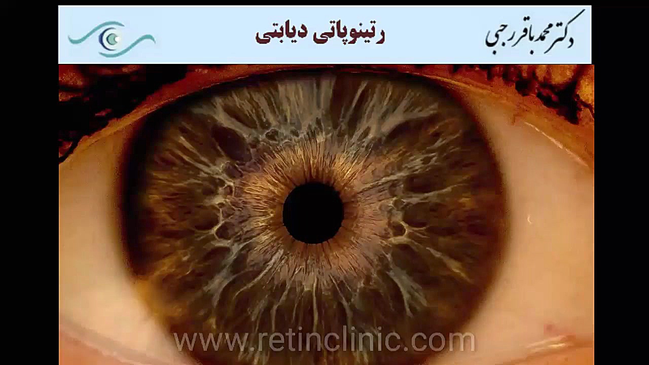 رتینوپاتی دیابتی دکتر محمد باقر رجبی -فوق تخصص شبکیه و لیزر
