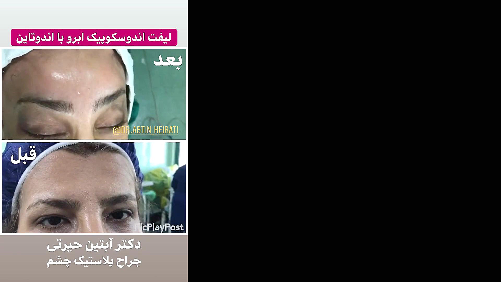 لیفت ابرو با اندوتاین توسط دکتر آبتین حیرتی پزشکی شخصی‌سازی‌شده سطح یاخته‌ای