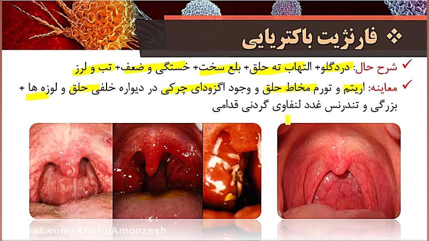 درمان فارنژیت باکتریایی سلنا گومز