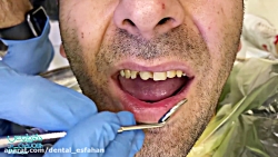 فیلم تعویض کامپوزیت دندان شکسته و فاصله دار